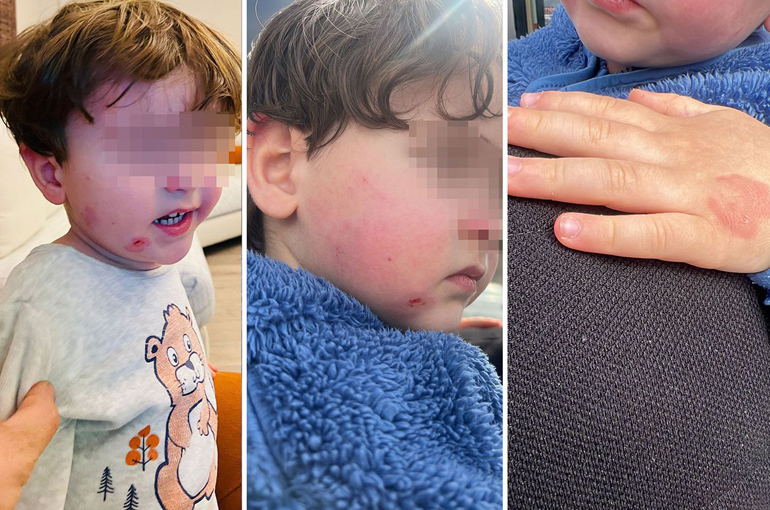 Bursa'da Kreşte 2,5 Yaşındaki Çocuğa Darp İddiası!