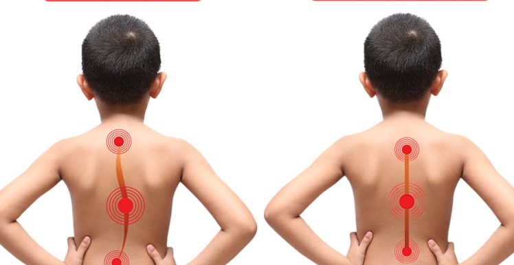 ''Skolyoz, çocuklarda yüzde 4-5 civarında görülebiliyor''