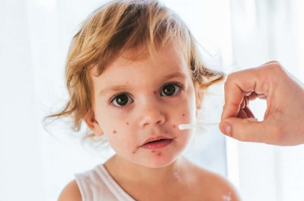 Uzmanlardan suçiçeği uyarısı